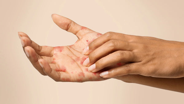 Caring for eczema-prone skin